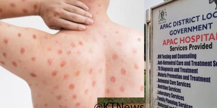 Apac Seeking UGX 240M for Mpox Response Activities