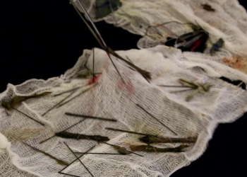 Surgeons Took 8 Hours to Extract 50 Needles plus Broken Pens inside Tortured Boy’s Stomach