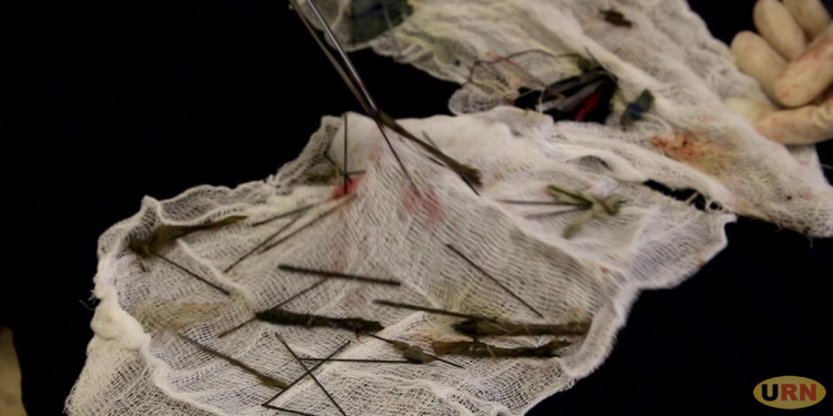 Surgeons Took 8 Hours to Extract 50 Needles plus Broken Pens inside Tortured Boy’s Stomach