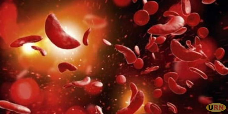 Nalufenya Hospital Registers 800 Cases of Sickle Cell Disease per Monthly